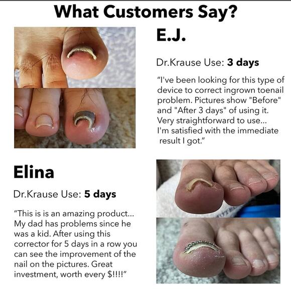 Ingrown Toenail Correction Kit- Dr. Krause- Nail Corrector New In Box - Picture 4 of 6